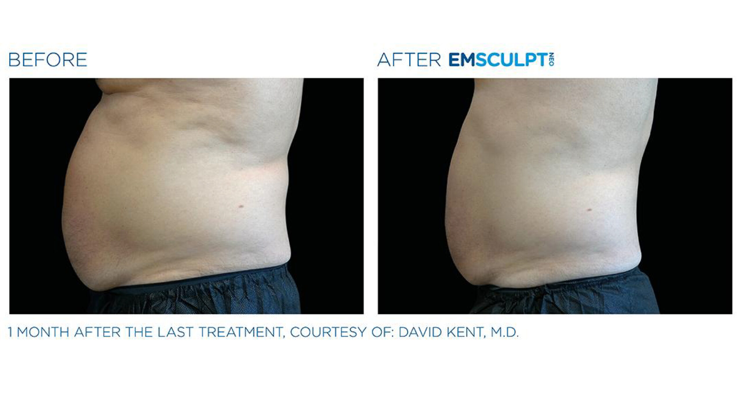 Top Form Care - EMSCULPT NEO 11